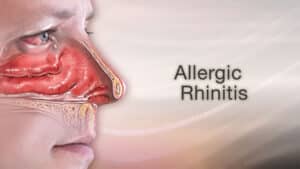 Understanding Allergic Rhinitis: Causes, Symptoms, and Treatment Options