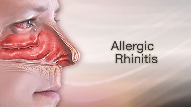 Understanding Allergic Rhinitis: Causes, Symptoms, and Treatment Options