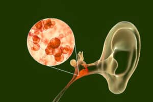 Understanding Chronic Otitis Media: Causes, Symptoms, and Treatment